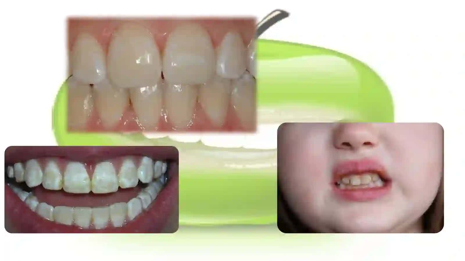 Dogʻ shaklidagi sistemali emal gipoplaziyasi 4