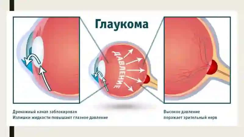 Glaukoma 4