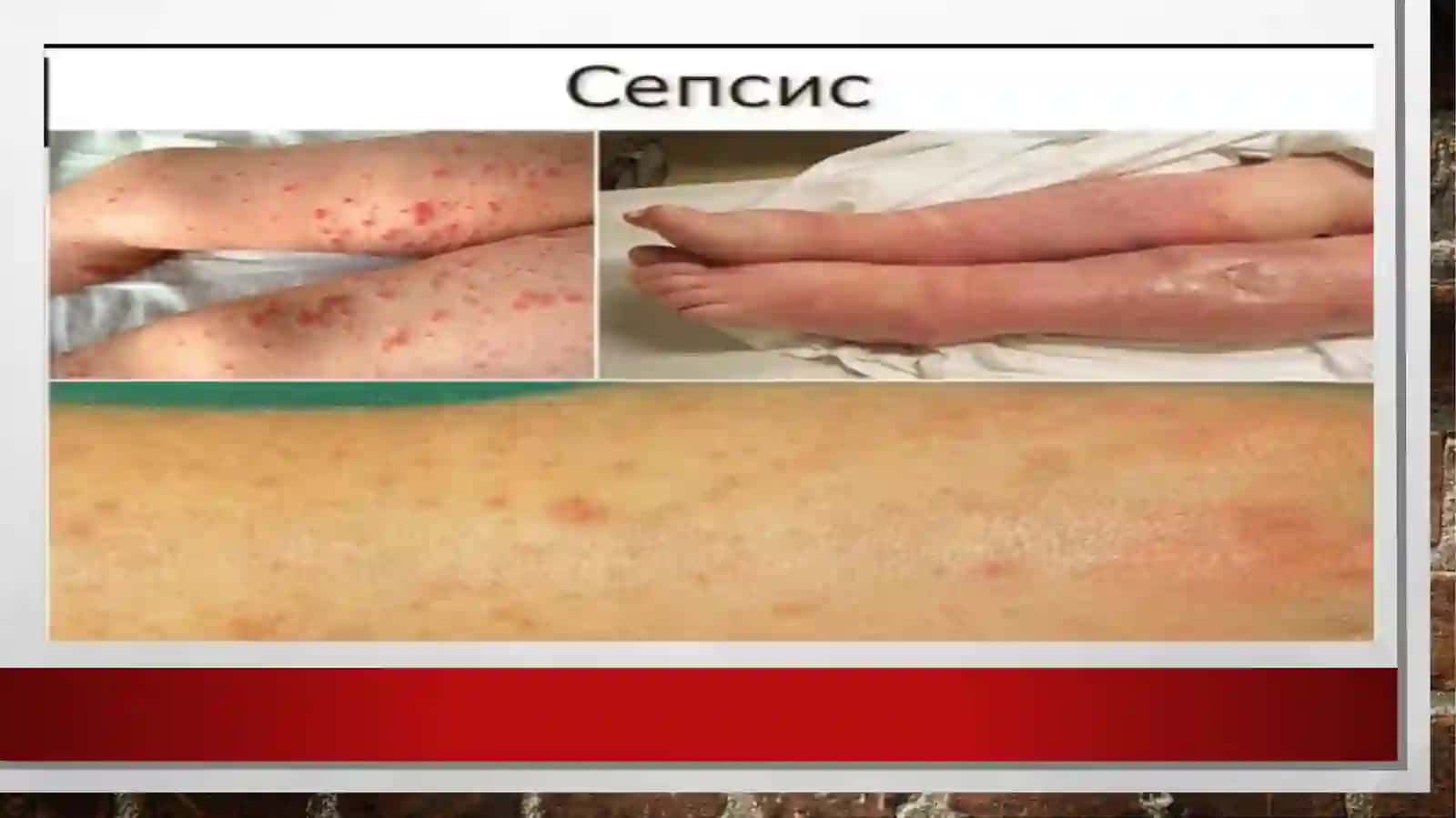 sepsis kasalligi 4