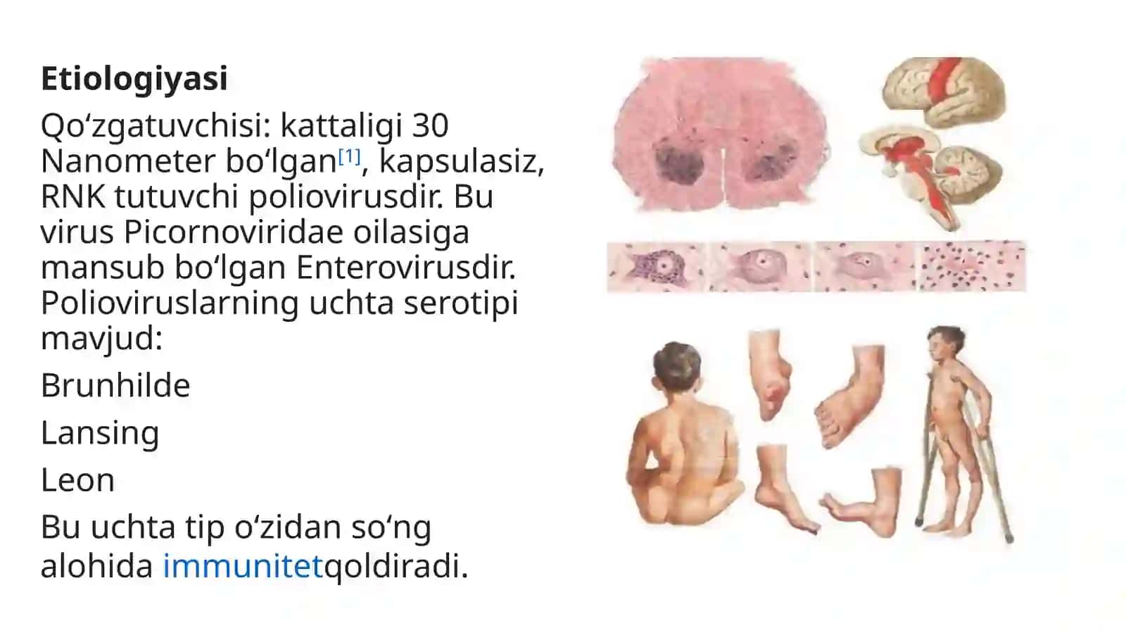 Poliomiyelit 4