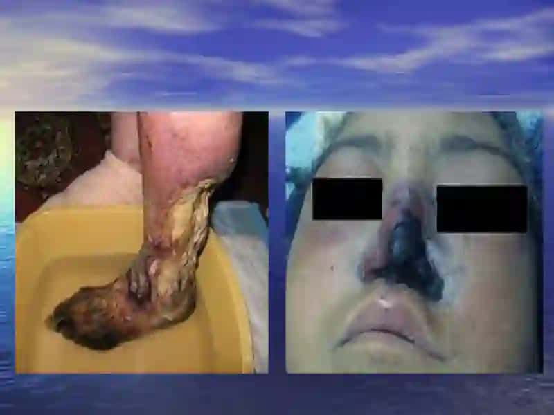 gangrena 4