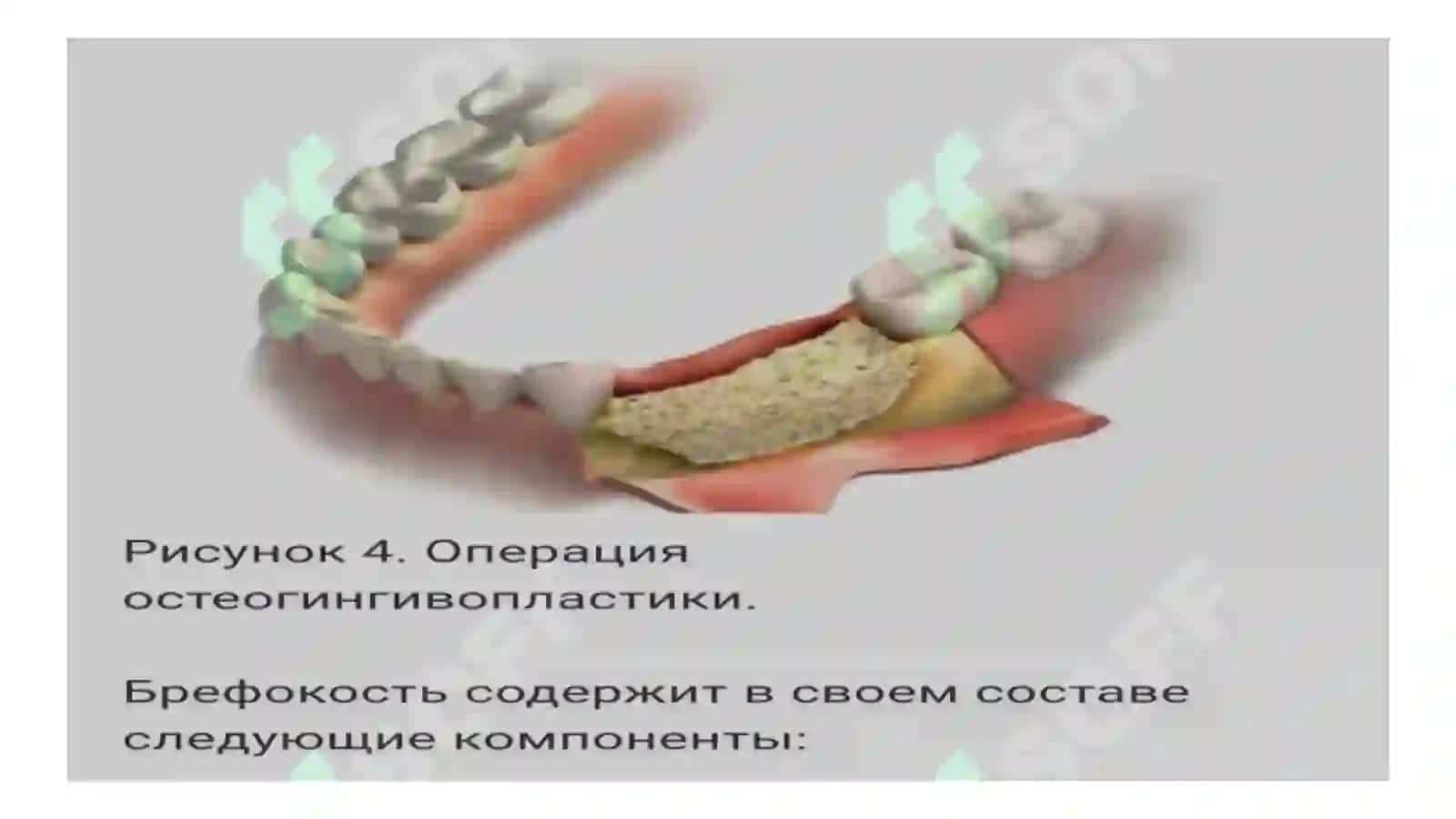 Parodontal xirurgiyada qattiq toʻqimalar transplantatsiyasi 4
