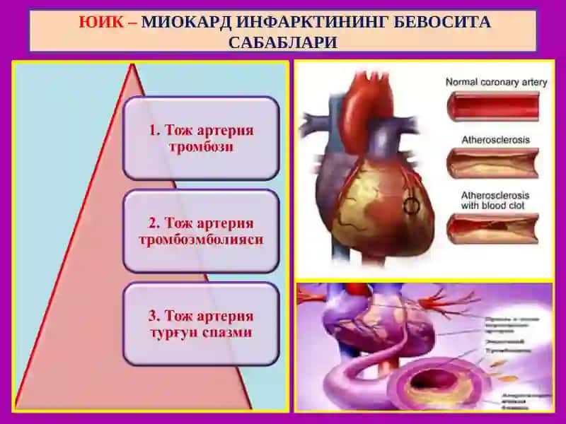 Юрак ишемик касаллиги 4