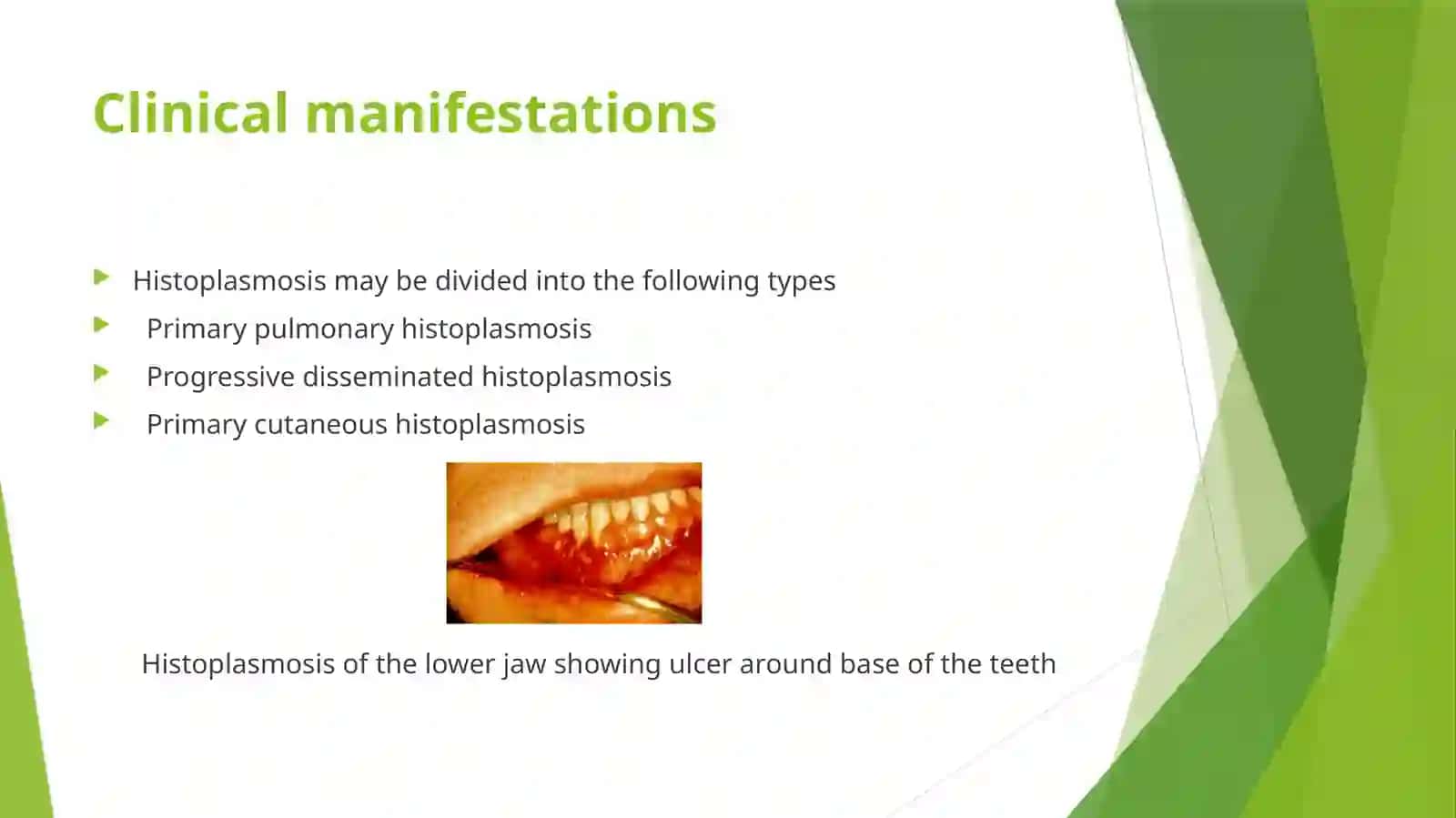Histoplasmosis 4