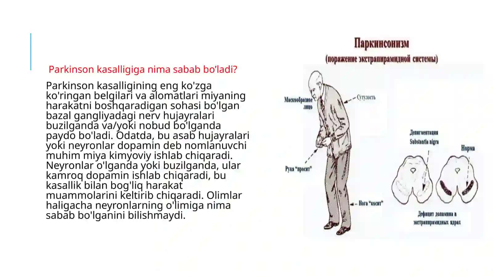 Parkinson kasalligini davolash 4