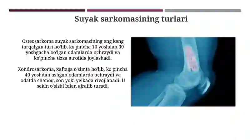 Suyak sarkomasi 4