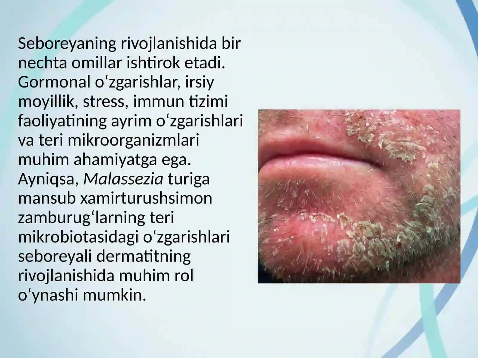 Seboreya. Pushti rangli xusnbuzarlar. Chaqaloqlarning yiringli kasalliklari 4