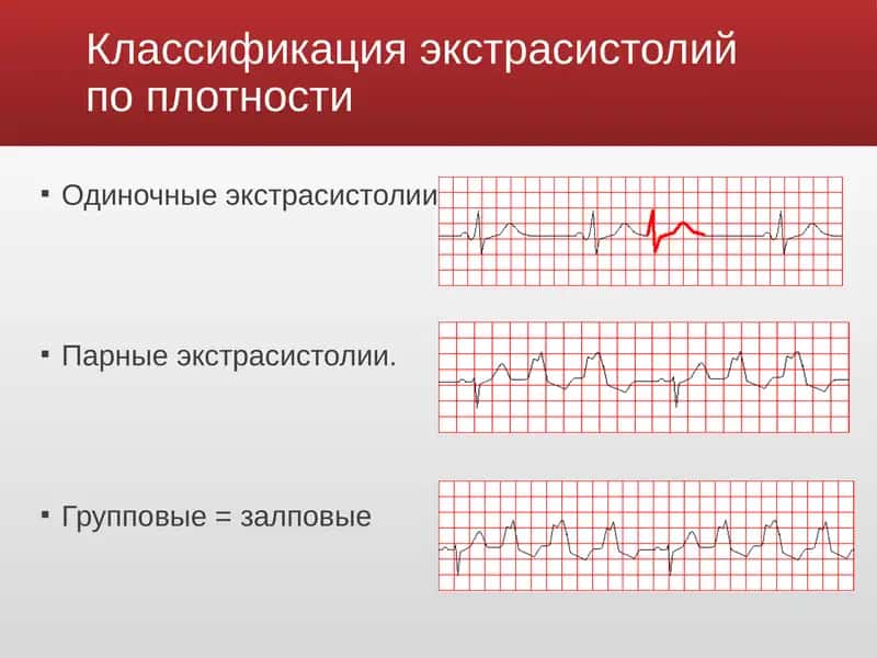 Экстрасистолии 4