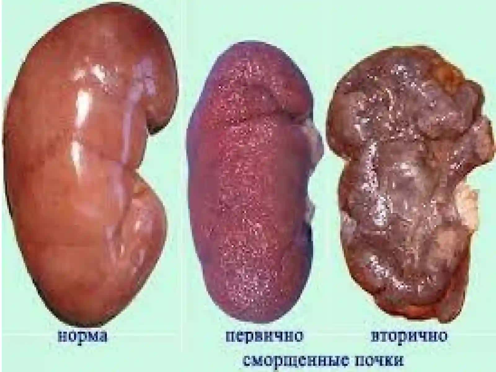 Сурункалибуйраккасаллиги 4