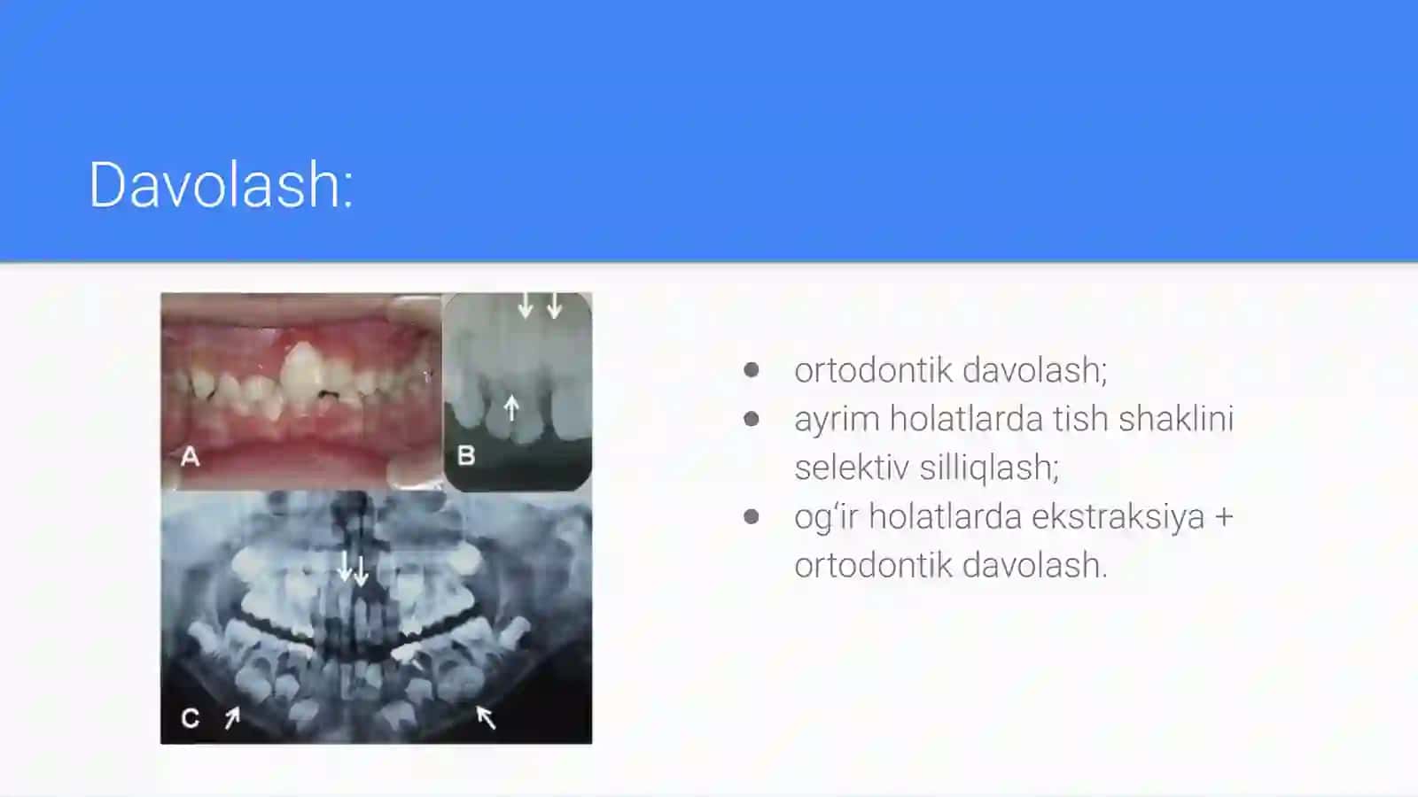 Tishlarni xajm va miqdor anomaliyalari. Tishlar retensiyasi. Sabablari.  Davolash usullari. Adenti 4