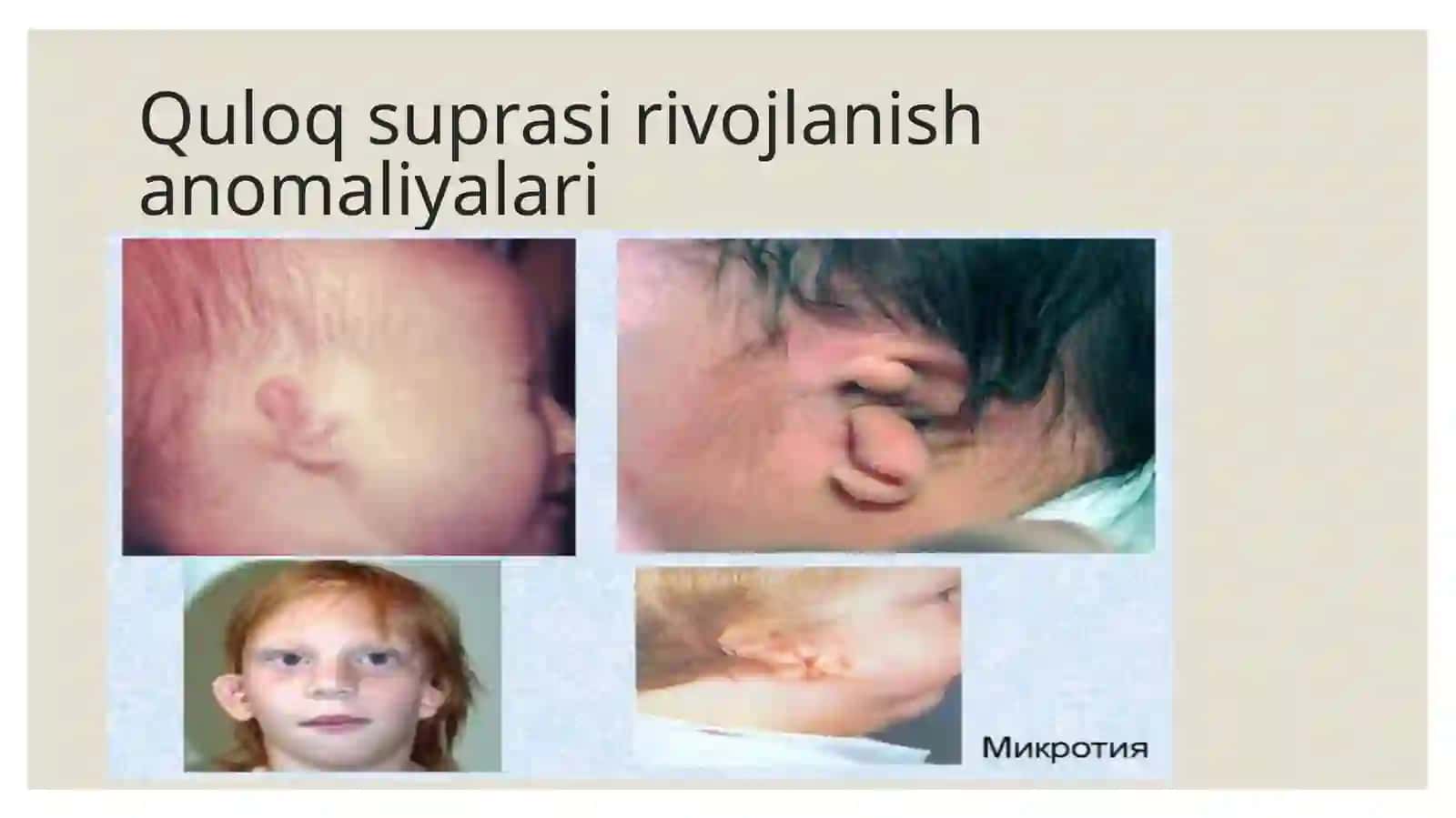 Quloqsuprasirivojlanishanomaliyalari 4