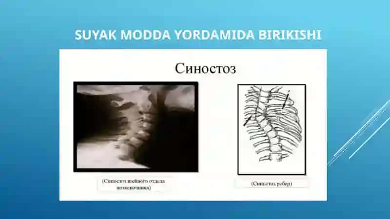SINDESMOZ SINXONDOZ VA SINOSTOZ 4