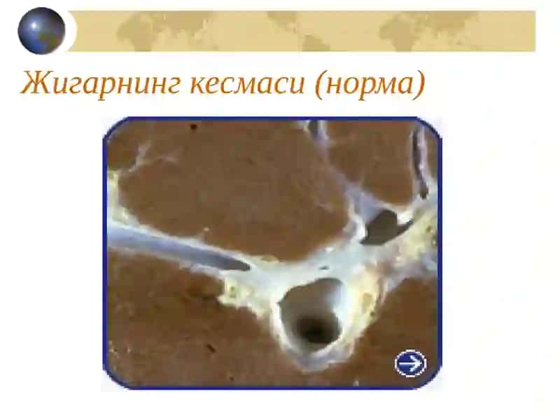 Сурункали гепатит 4
