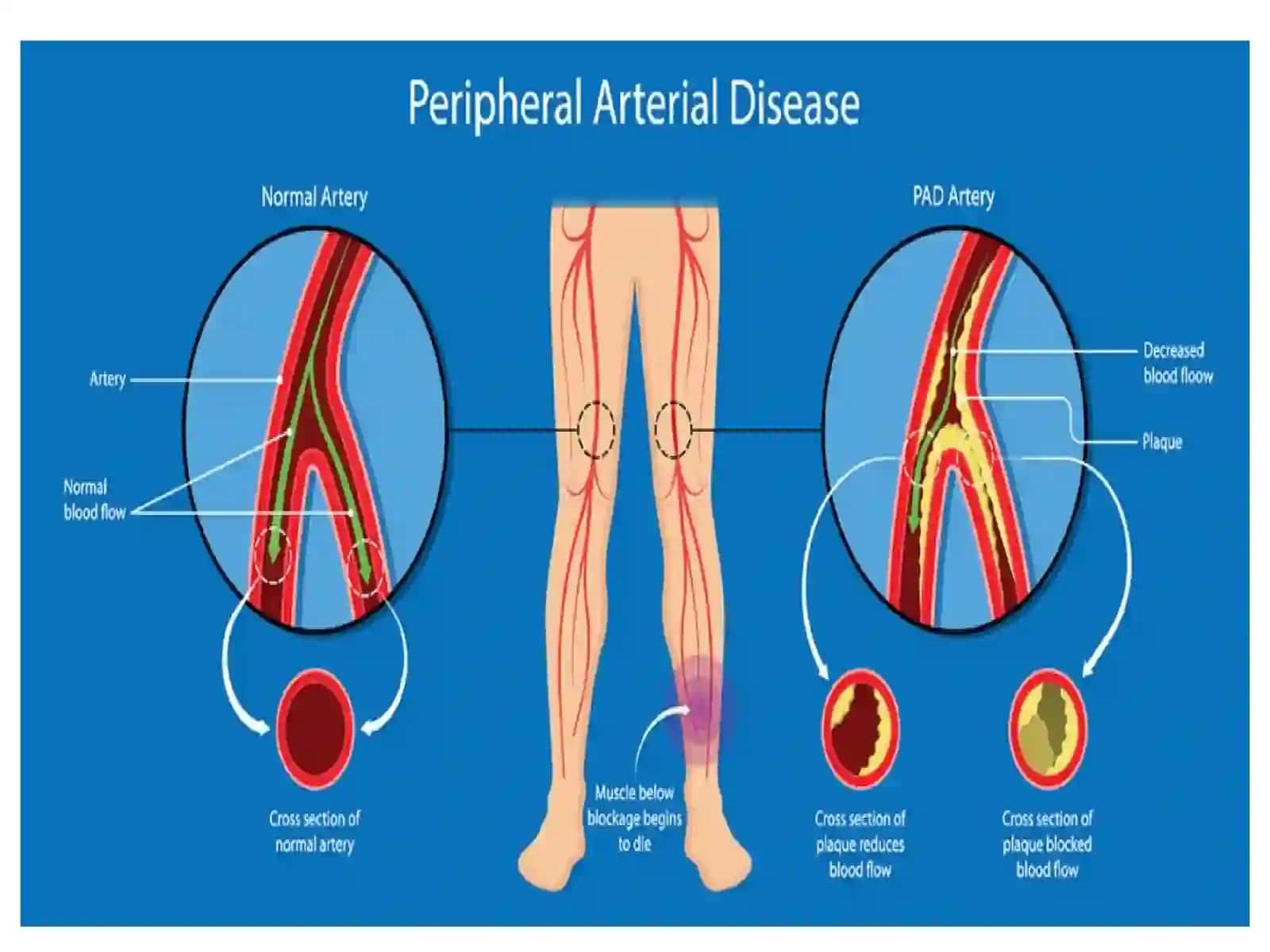 Arterial qon tomirlarni surunkali obliteratsiyasi 4