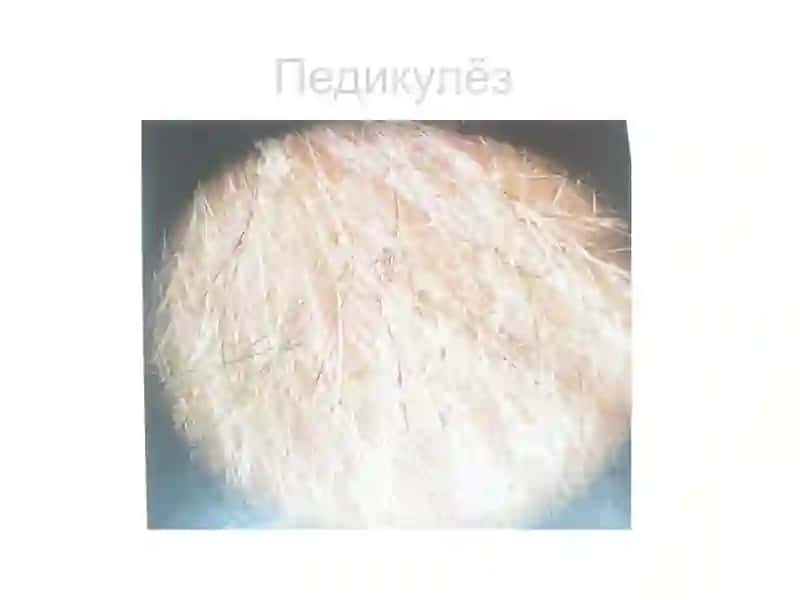 Педикулёз (битлаш) 4