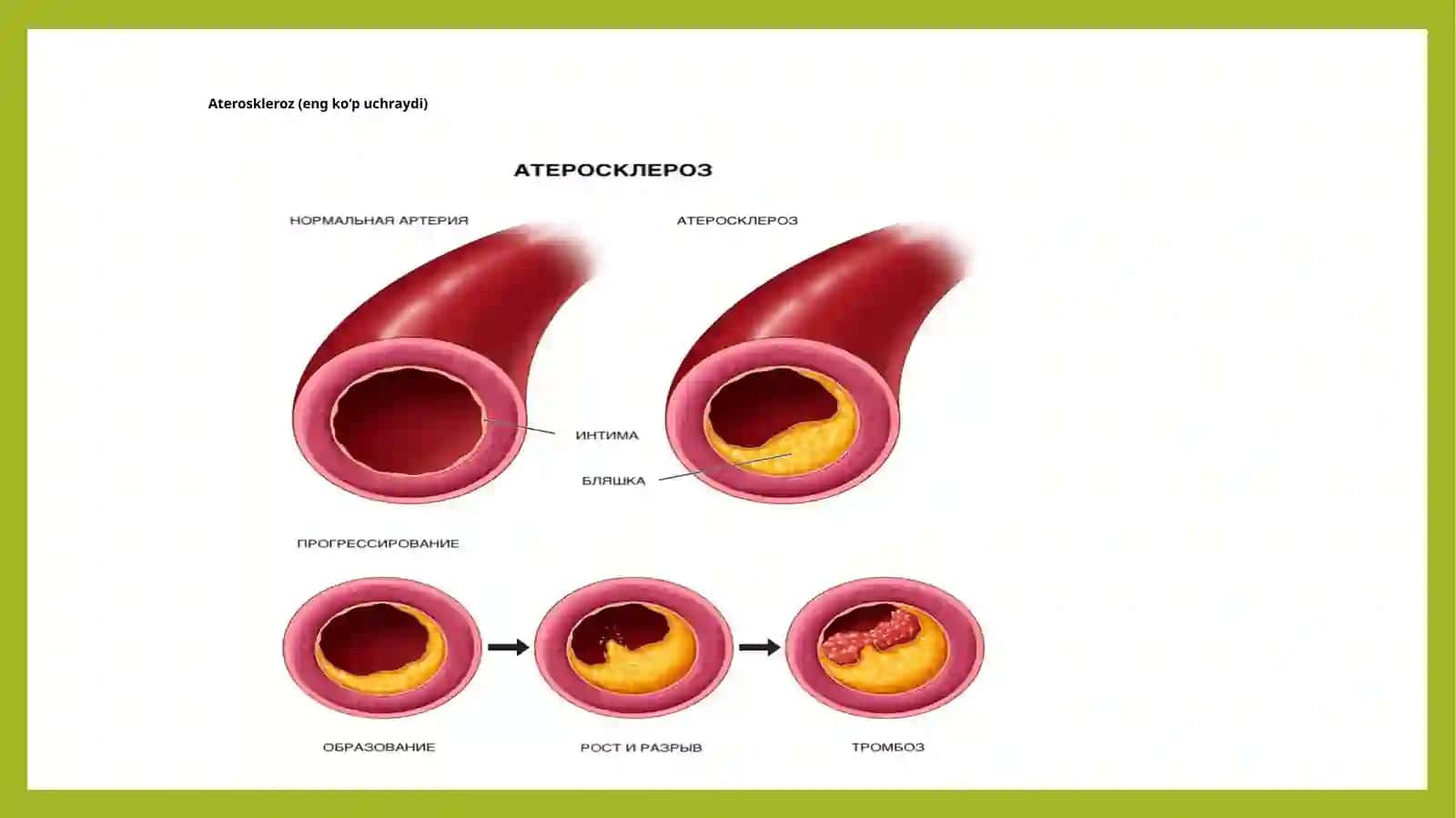 Arterial qontomirlar nisurunkali obliteratsiyasi davriy va olam hozirdagi volash usullari 4