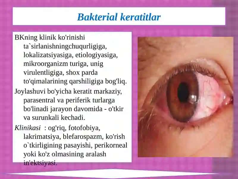 KO`ZNING OLDINGI SEGMENT KASALLIKLARI 4