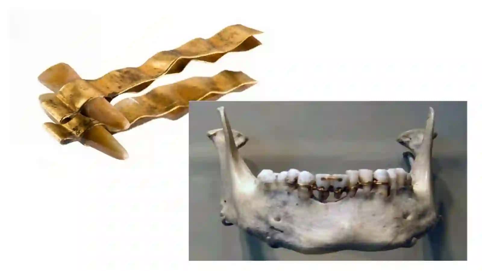Dentalimplantlar tarixi 4