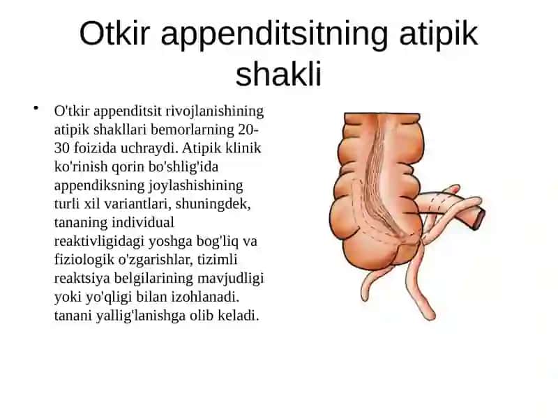 O’tkir appenditsit atipik kechishi 4