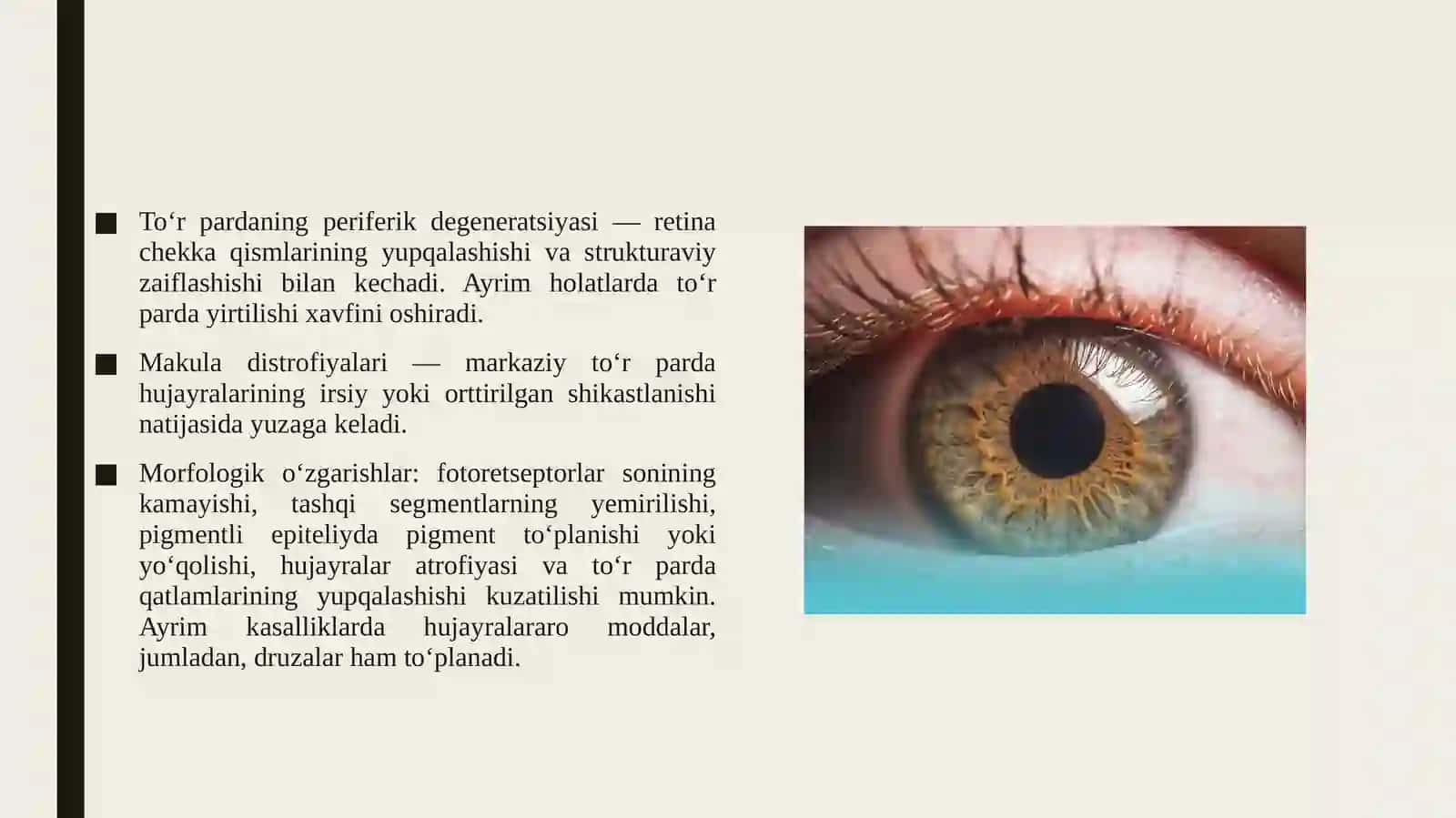 Ko‘z to‘r pardasi degenerativ kasalliklari. Uveit. Katarakta. Retinopatiyalar. To‘r parda o‘smalarini morfologiyasini o'rganish. 4