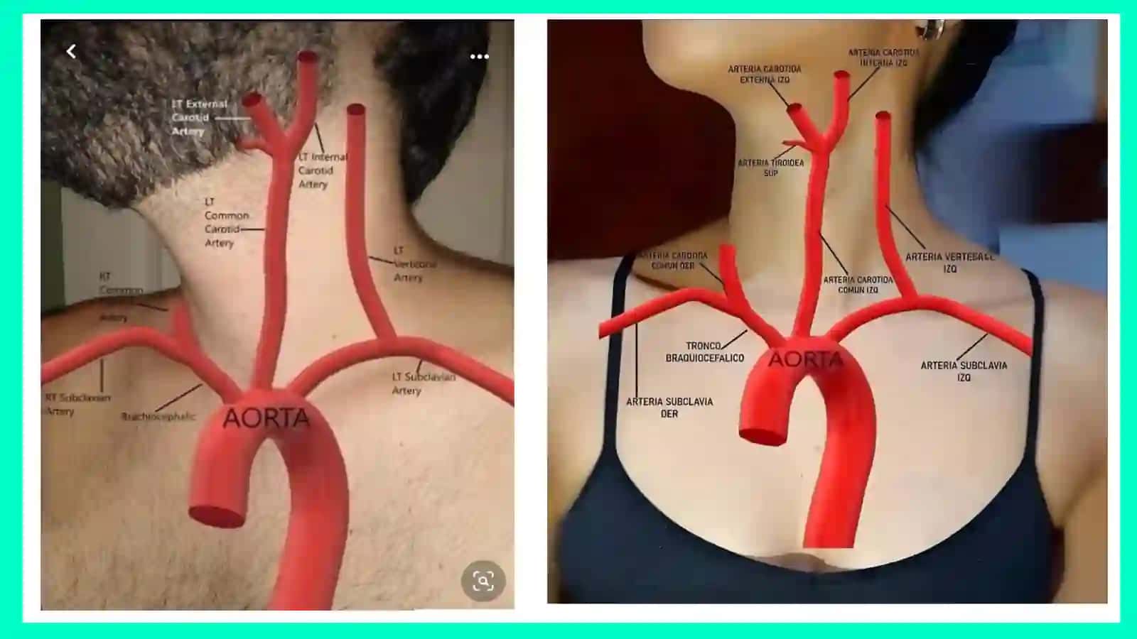Aorta 4
