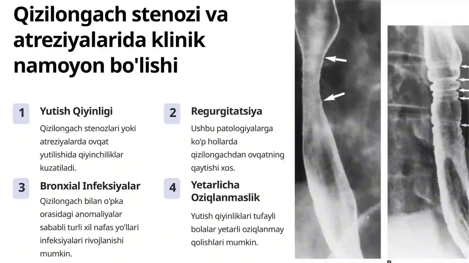Qizilo'ngach stenozi va atreziyalarida operatsiyalar. Bolalarda traxeya-qizilongach oqimlari operatsiyalari 4