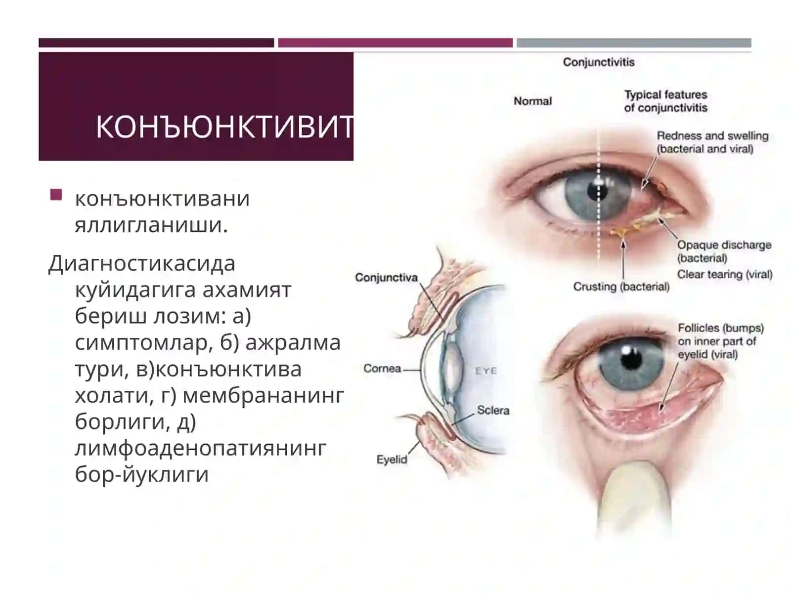 КОНЪЮНКТИВА КАСАЛЛИКЛАРИ 4