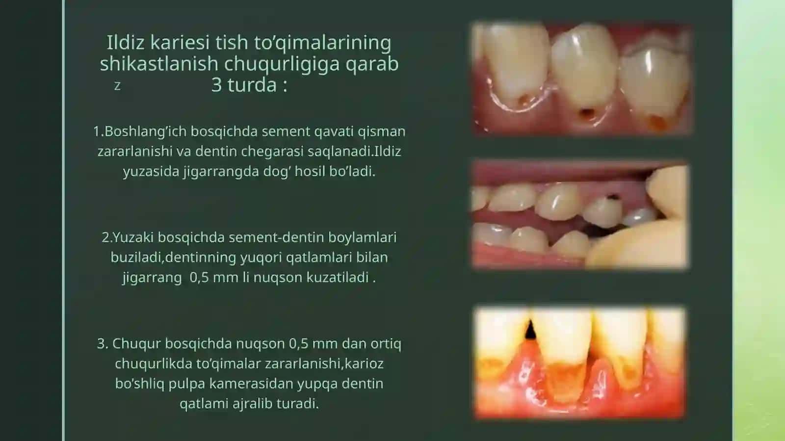 Ildizkariesi,klinikasi,tashxislashvadavolash 4
