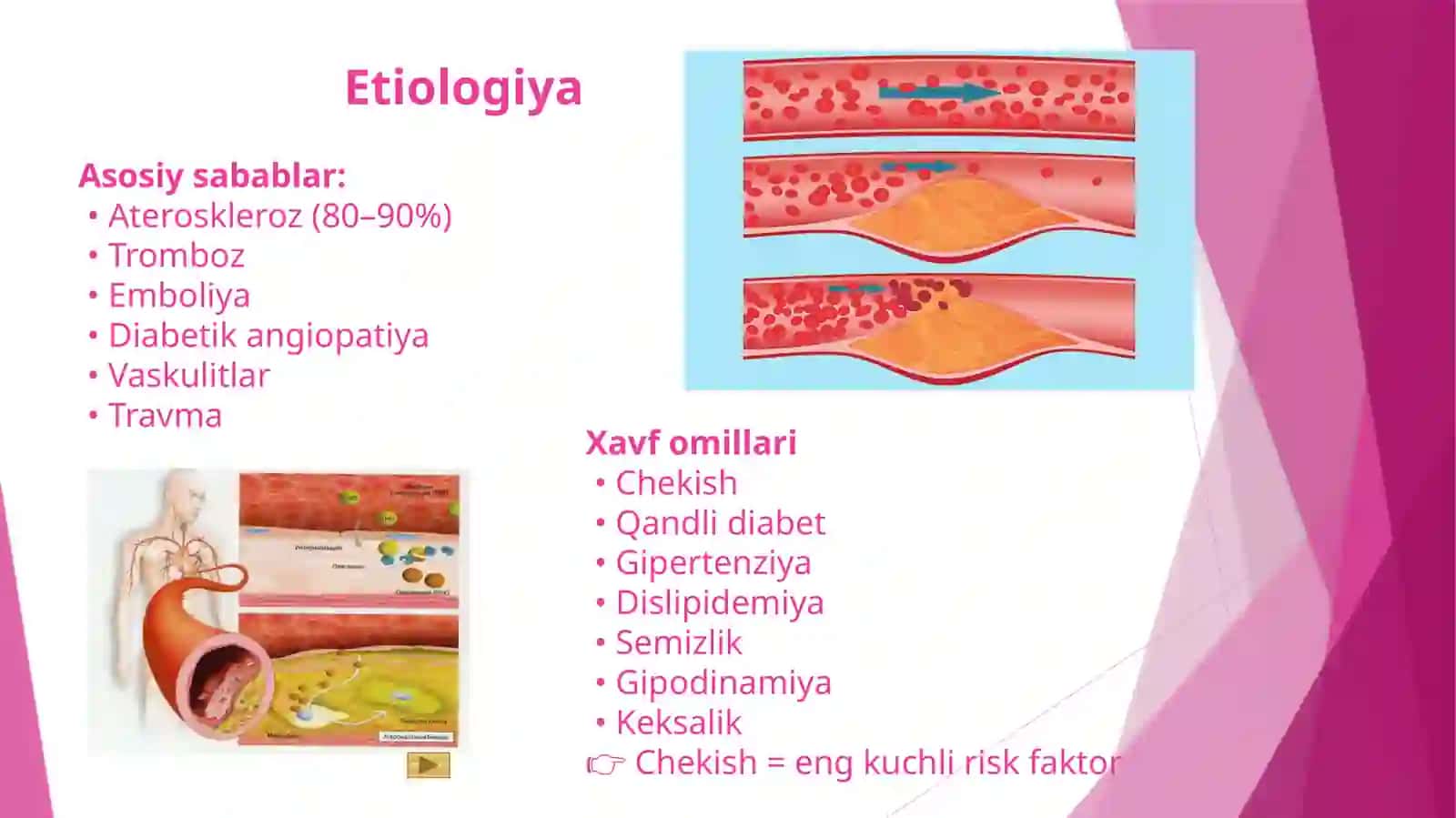 Qorin aortasi va oyoq arteriyalari okklyuzion kasalliklari. Endovaskulyar xirurgiya 4