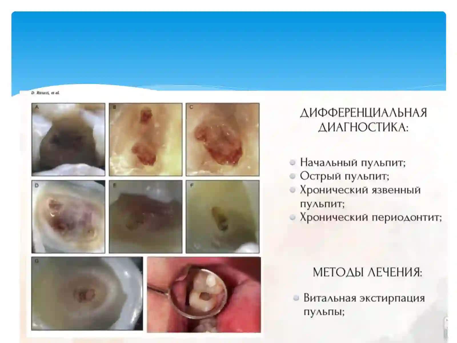 ХРОНИЧЕСКИЕ ФОРМЫ ПУЛЬПИТОВ,КЛАССИФИКАЦИЯ ДИАГНОСТИКА И КЛИНИКА 4