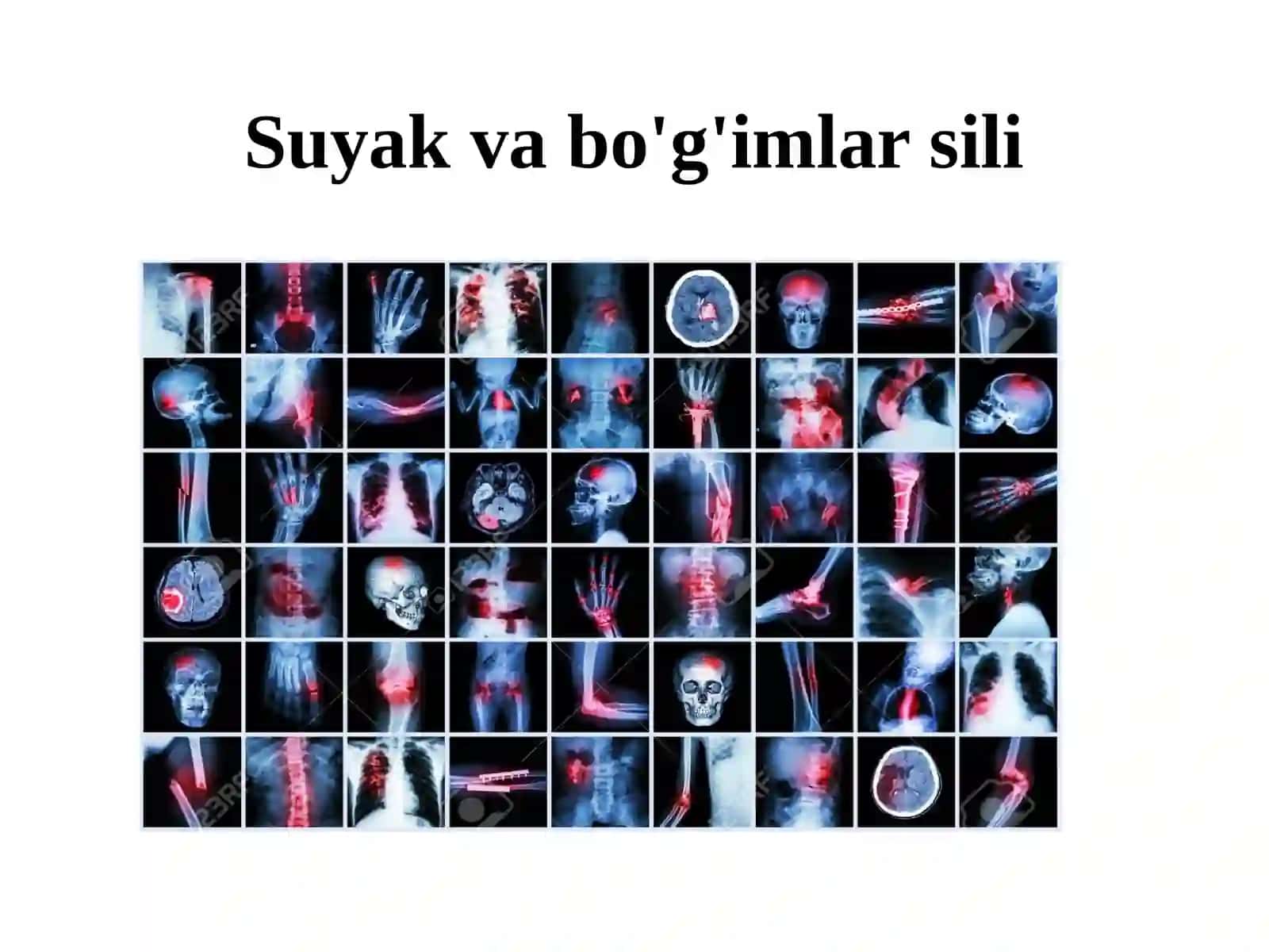 Suyak va bo‘g‘imlar sili 4