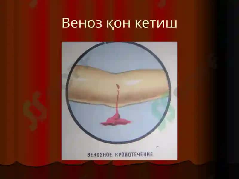 Қон кетиш 4