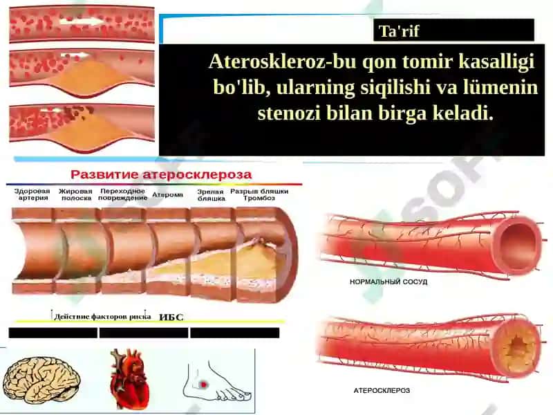 Yurak ishemik kasalliklarini operativ davolashning zamonaviy usullari 4
