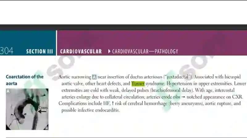Shershevskiy-Turner syndrome 4