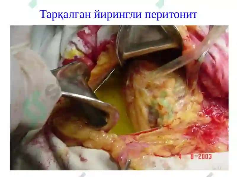 Ўткир перитонит 4