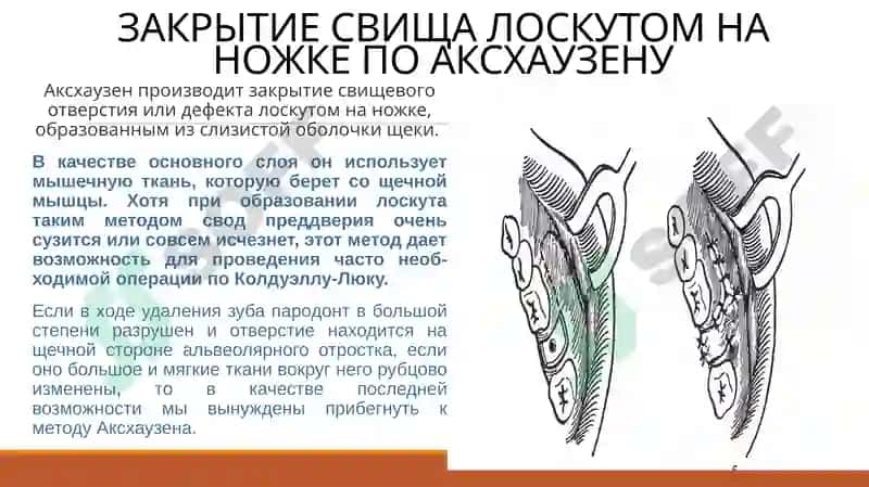 СПОСОБЫ ХИРУРГИЧЕСКОГО ЗАКРЫТИЯ СООБЩЕНИЯ МЕЖДУ ГАЙМОРОВОЙ ПАЗУХОЙ И АЛЬВЕОЛОЙ 4