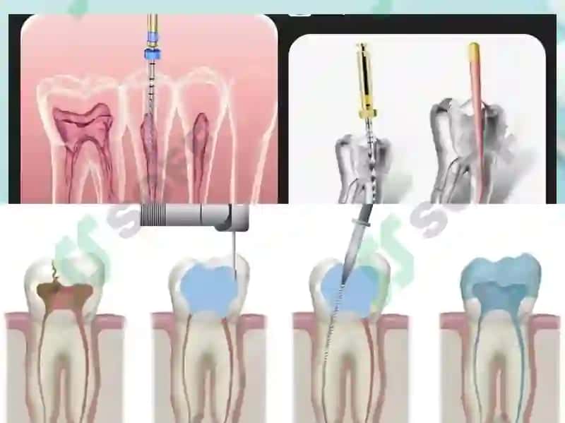 Endodontiya tushunchasi va davolash usullari 4