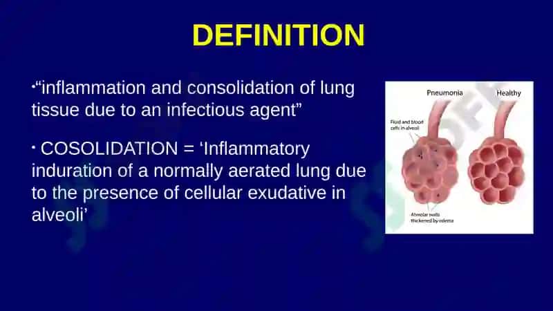 Pneumonia 4