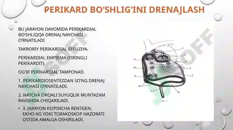 Perikarditlarda operatsiyalar 4