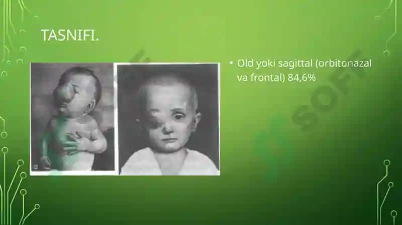 TUG'MA NUQSONLAR. BOLALARDA MIYA CHURRASI VA YURAK NUQSONLARI 4