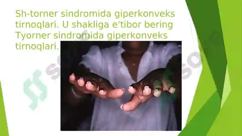 Sheresheviski-Terner sindromi 4