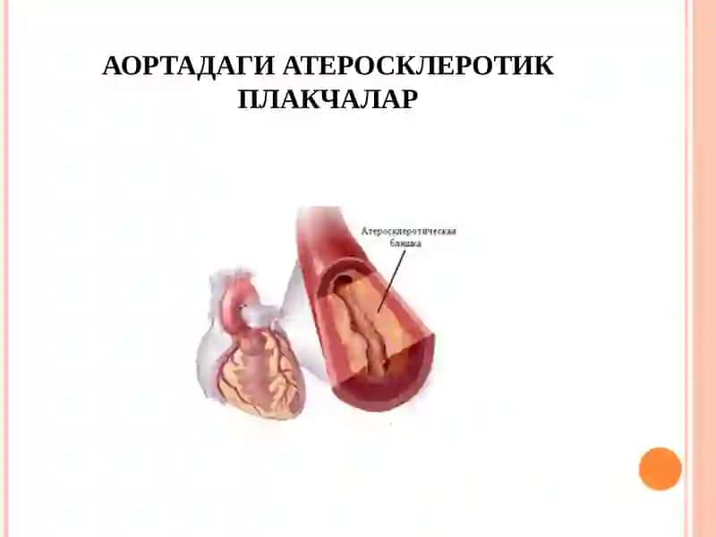 Миокард инфаркти 4