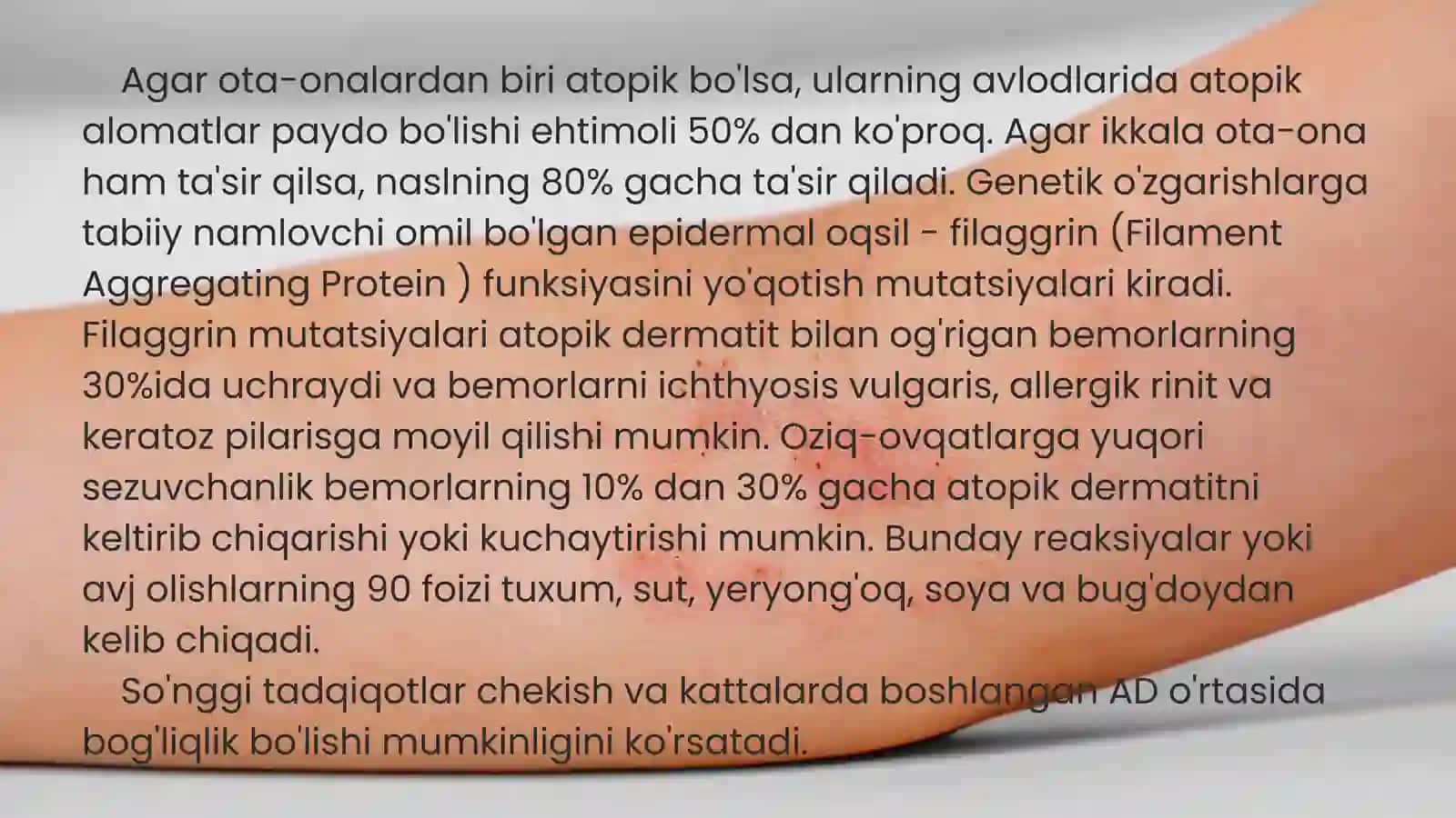 Atopik dermatit 4