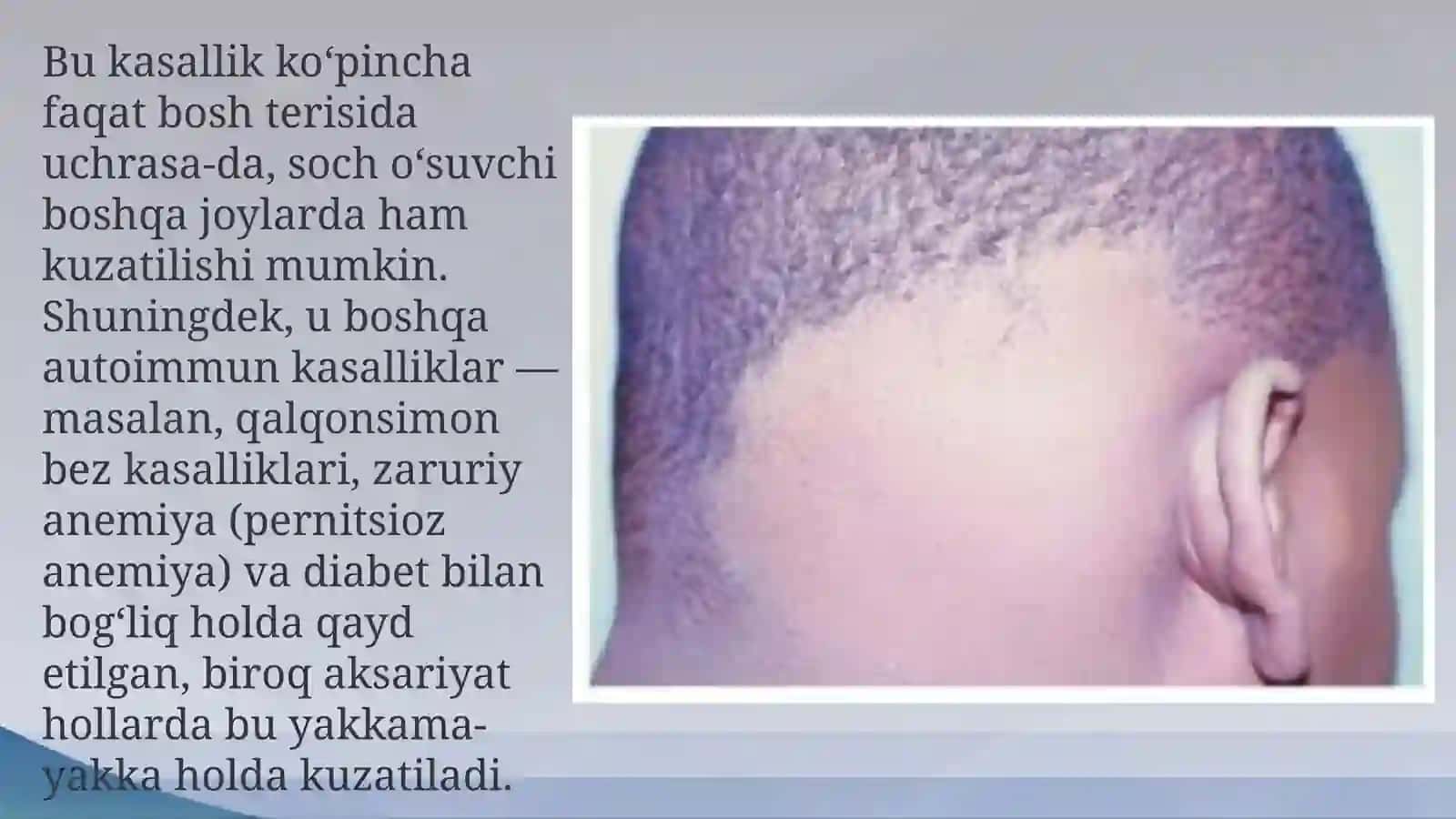 ALLOPECIAni davolashning zamonaviy usullari 4