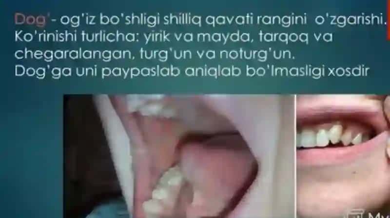 Og’iz bo’shlig’i shilliq qavatining birlamchi va ikkilamchi morfologik elementlarini tuzilishi 4