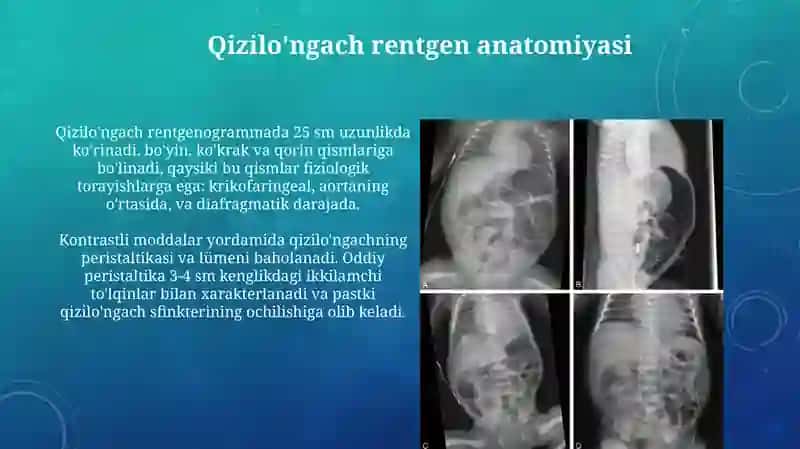 Hazm a'zolarining rentgen anatomiyasi va rivojlanish nuqsonlari 4
