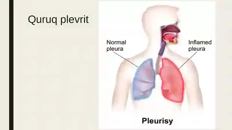 Plevra bo'shlig'idagi havo va suyuqlik to'planish sindromi.  Plevrit. Gidrotoraks. Pnevmotoraks 4
