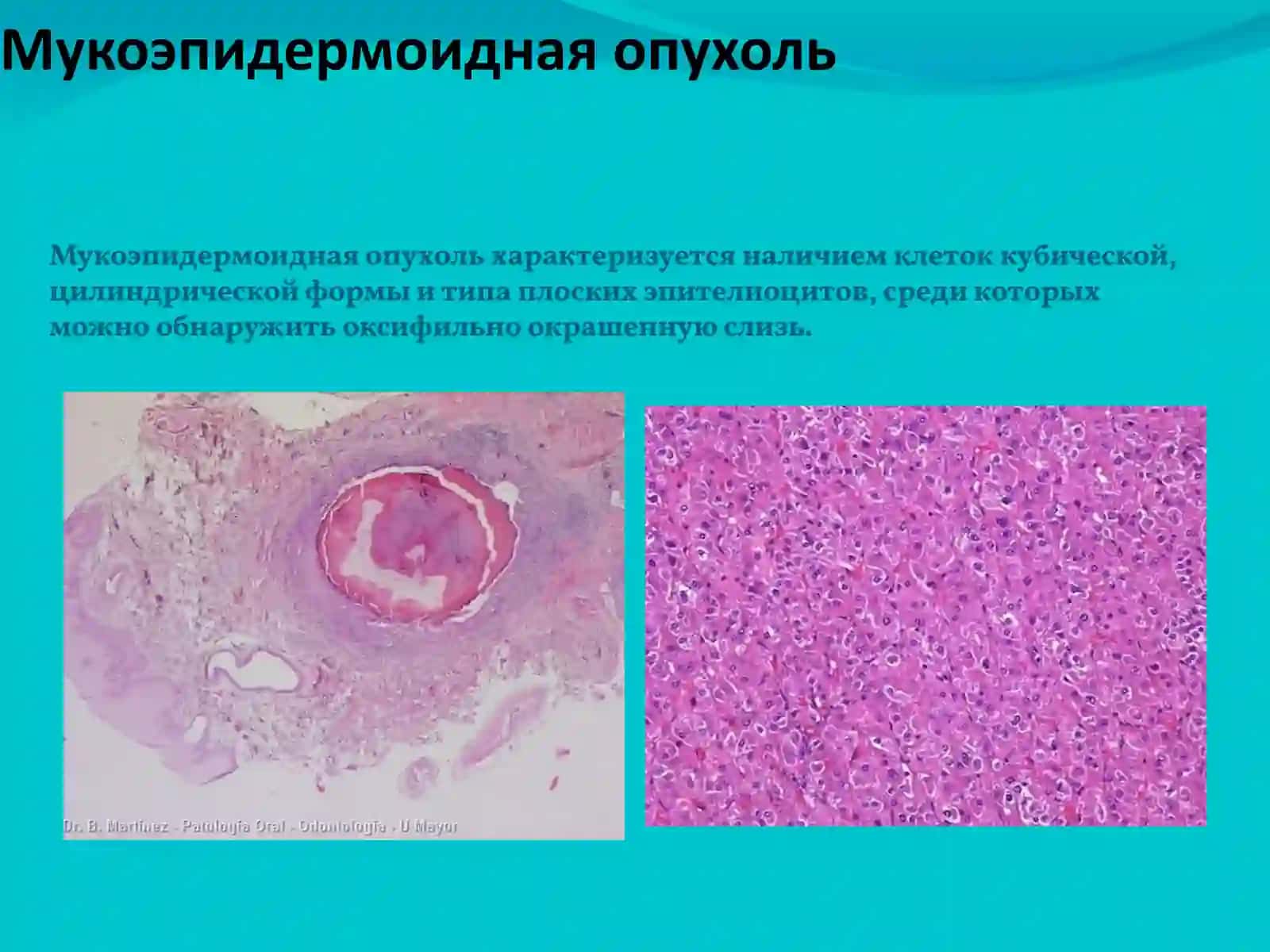 Злокачественные опухоли слюнных желез 4
