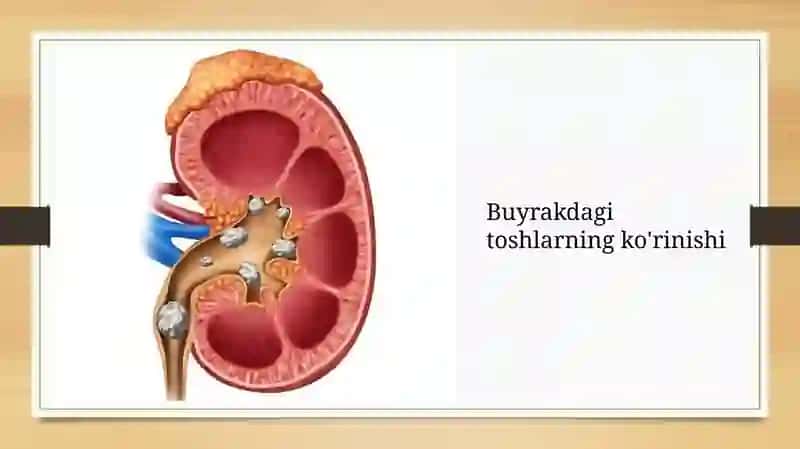 Buyraklarda urat toshlarining hosil bo'lishi va ularning davolash yo'llari 4
