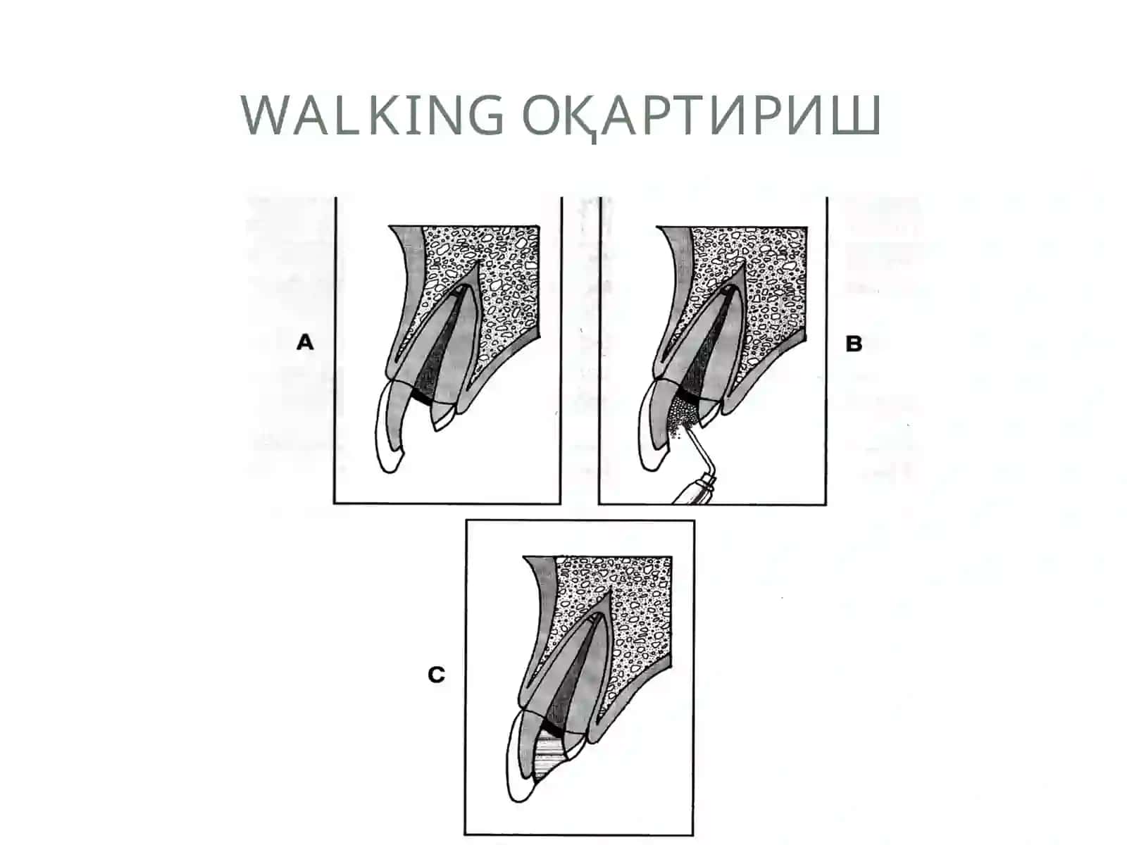 Тишларни оқартириш усуллари 4